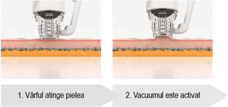 ZIMMER reLift – Aparat de radiofrecvență cu microneedling si HIFU
