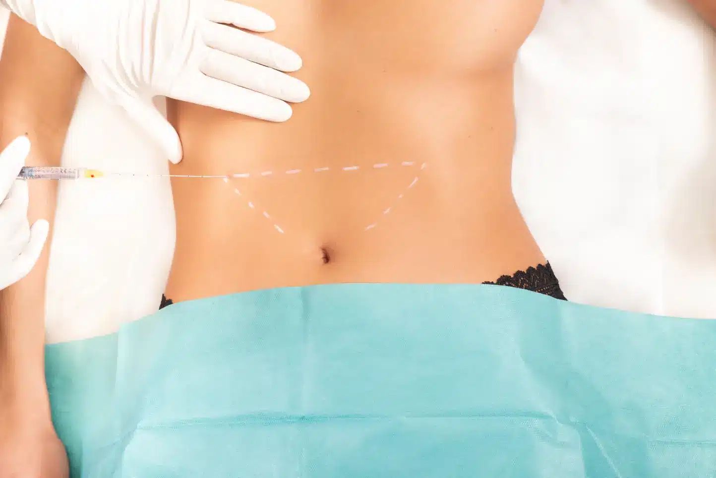 Microcanula 30G 25mm XL, SoftFil Precision product image 13