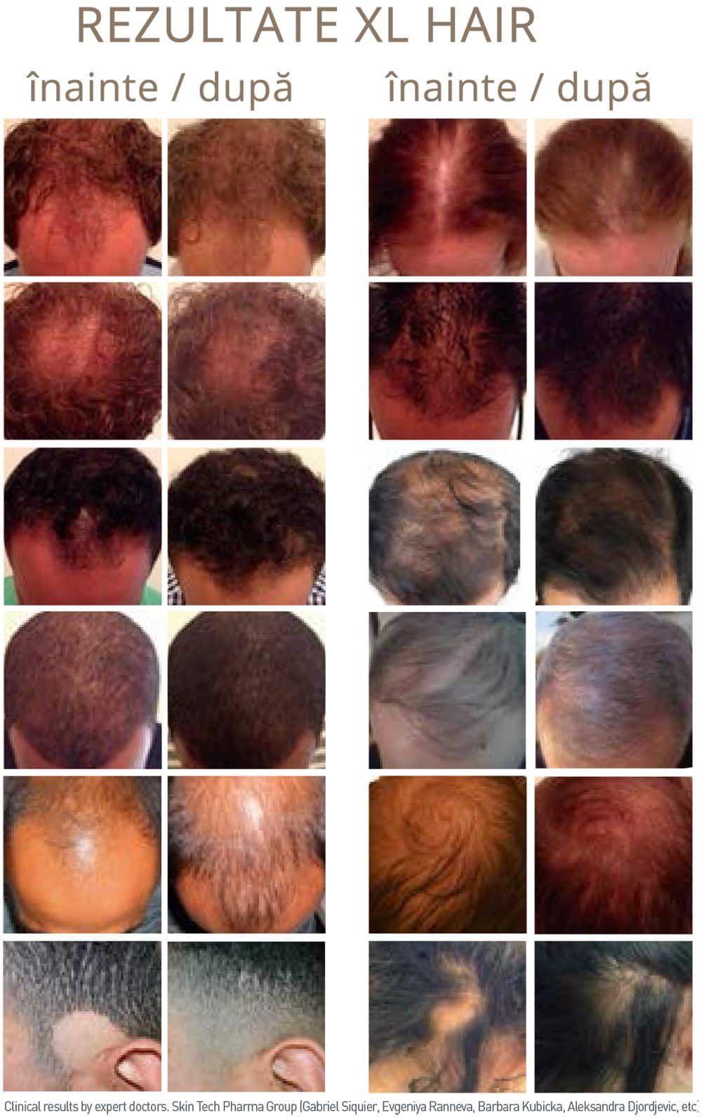 XL Hair - tratament pentru caderea parului product image 2