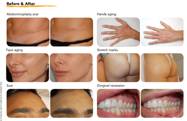 LINERASE – Sisteme de regenerare a pielii cu colagen product image 2