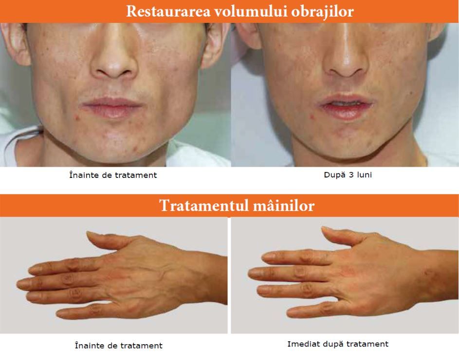 GANA V - Filler pe bază de acid polilactic product image 3