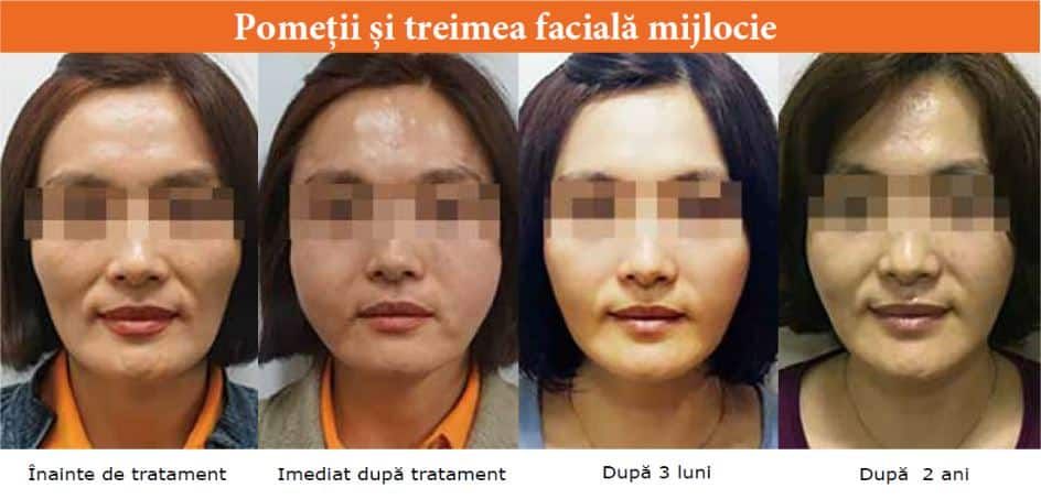 GANA V - Filler pe bază de acid polilactic product image 4
