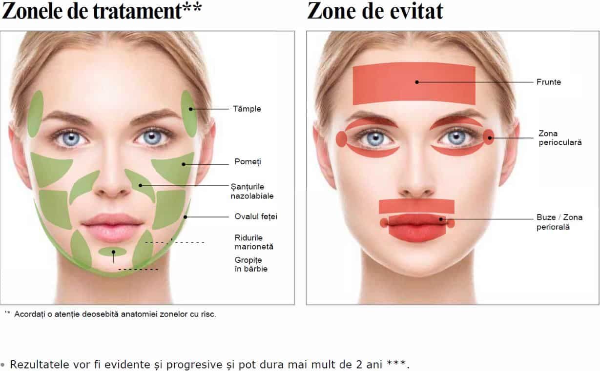 GANA V - Filler pe bază de acid polilactic product image 5