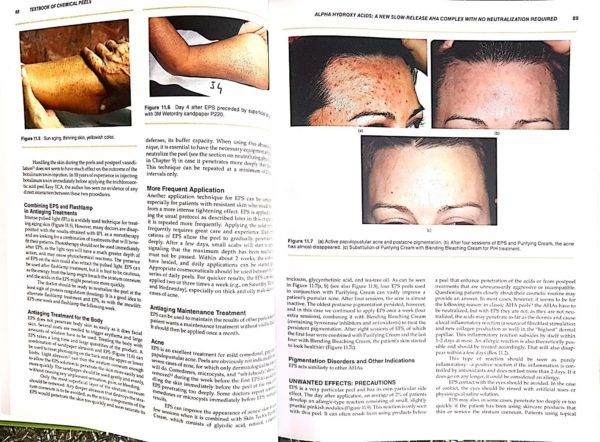 Textbook of Chemical Peels: Superficial, Medium, and Deep Peels in Cosmetic Practice 2nd Edition product image 2