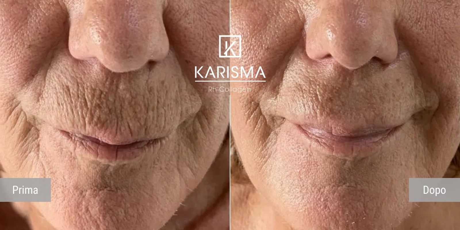 Karisma, rh colagen, seringa preumpluta 2 ml, TAUMED product image 2