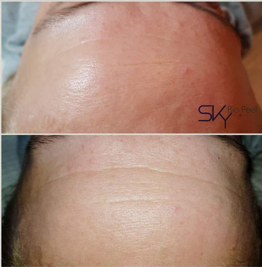 Peeling facial cu acid cloracetic, 6x5ml,Sky Bio Peel product image 3