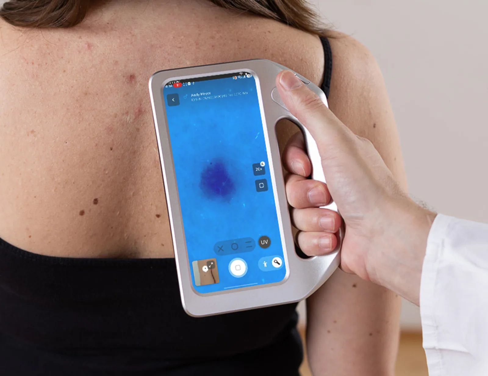 DermLite Skeen – dermatoscop cu analiză AI pentru piele și păr product image 5