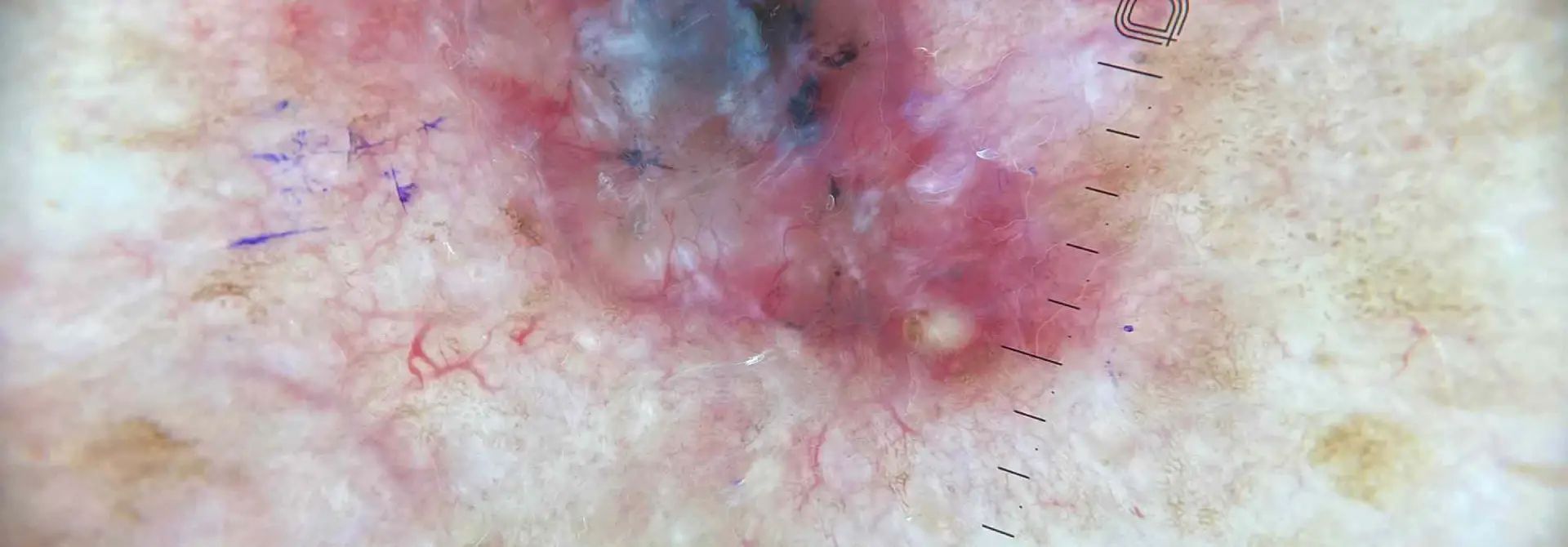 Dermatoscop Dermlite DL5, polarizare variabilă, lentile 32mm, mărire 10X product image 9
