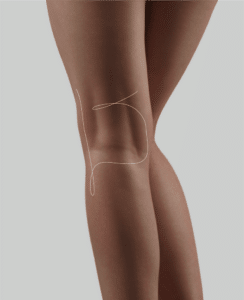 hyacorp mlf1, corectarea cavitatilor concave
